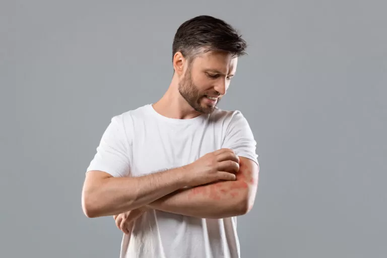 Dit zijn de symptomen van een alcohol allergie.