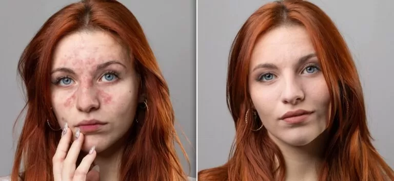 Dit zijn Voor en Na Foto's Stoppen met Alcohol.